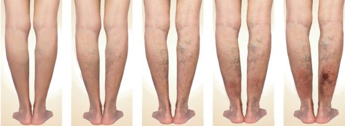 stages of varicose vein development