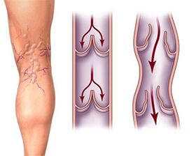 Normal operation of valves in a healthy vein and valve pathology in varicose veins