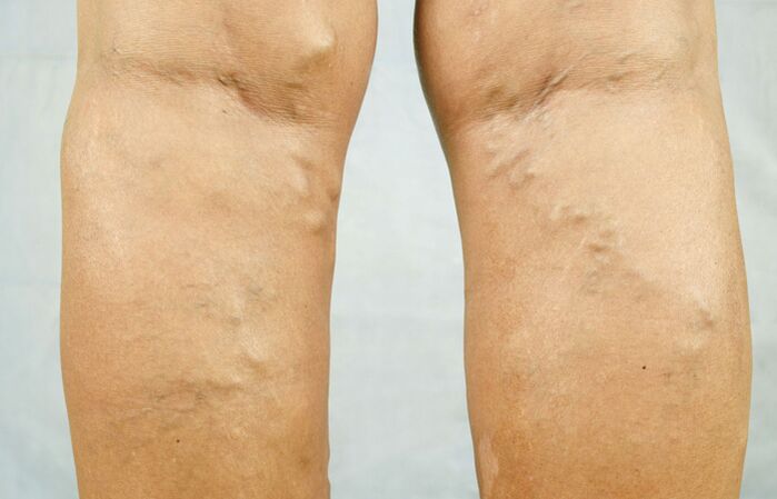 Varicose veins on the legs are the reason to consult a phlebologist