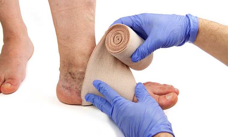 The treatment of varicose veins on the legs is completed by using compression stockings