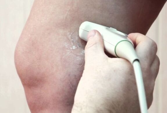 Varicose vein diagnosis