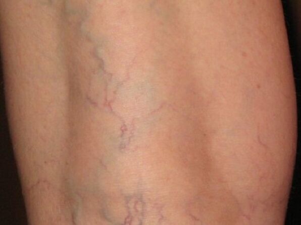 Varicose vein stages