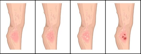 Degree of varicose veins
