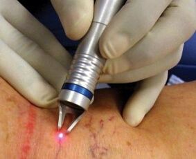 How is the laser treatment of varicose veins