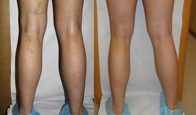 Laser treatment of varicose veins before and after
