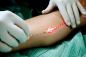 Laser treatment of varicose veins on their feet
