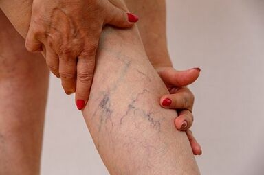 Varicose veins of the lower extremities