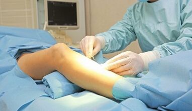Due to which symptoms varicose vein surgery is prescribed