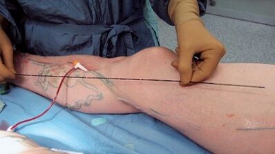 How varicose veins surgery is performed