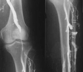 Possibilities of diagnosis of varicose veins of the extremities