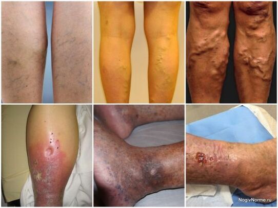 Difficulty damage to varicose veins
