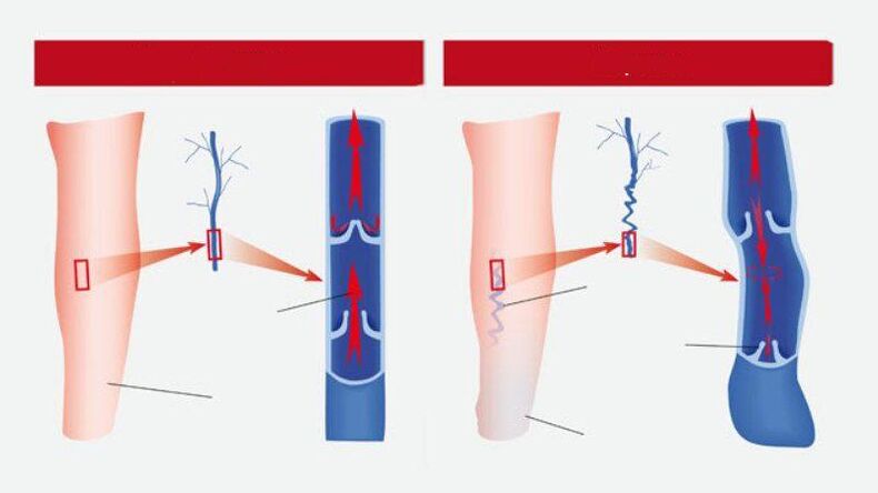 What varicose veins do look like