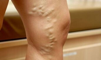 Signs and symptoms of varicose veins on their feet